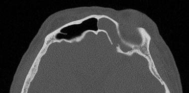 An axial CT of a patient with a spontaneous CSF le