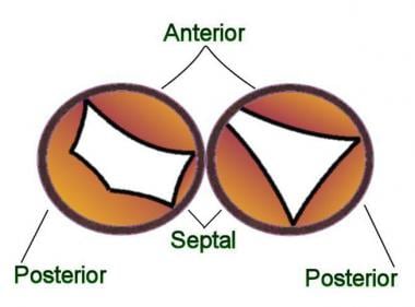 Partial atrioventricular septal defect (AVSD): The