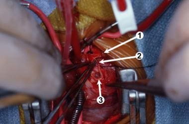 Intraoperative photograph. (1) The distal divided