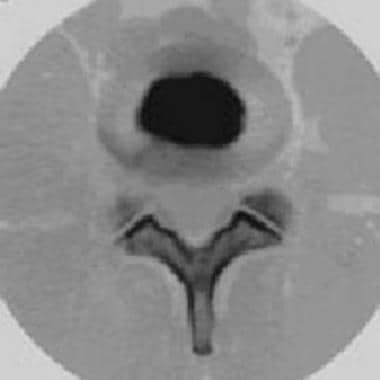 Postdiscography CT scan showing normal disk contou