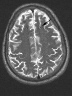 Brain, venous vascular malformation. Axial T2 imag