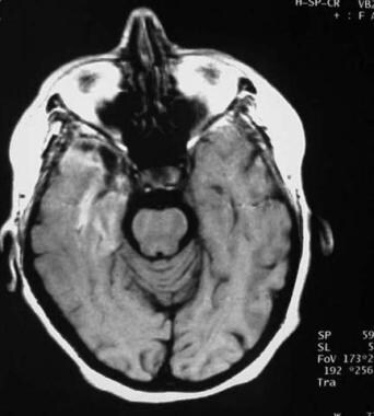 Axial gadolinium-enhanced T1-weighted image reveal