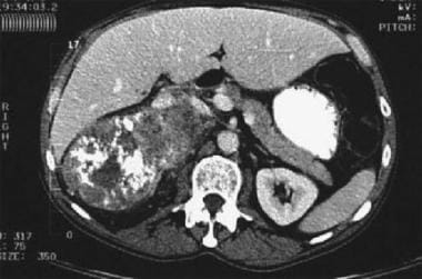 CT demonstrates a large heterogeneous mass, with f