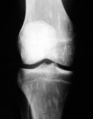 Osteopoikilosis. A plain film radiographic image o