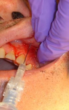 Intraoral approach for infraorbital nerve block. 