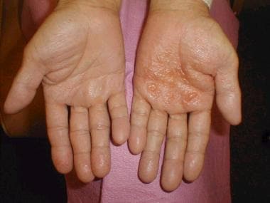 Dyshidrotic eczema (pompholyx). Tense vesicles and