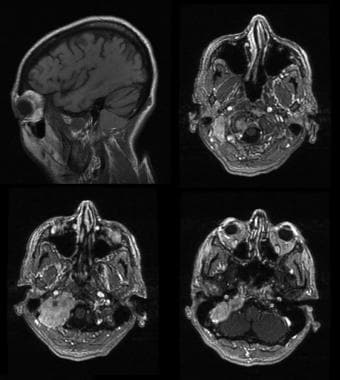 Intracranial plasmacytoma. Sagittal and axial T1-w