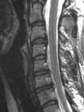 Sagittal magnetic resonance imaging (MRI) scan dem