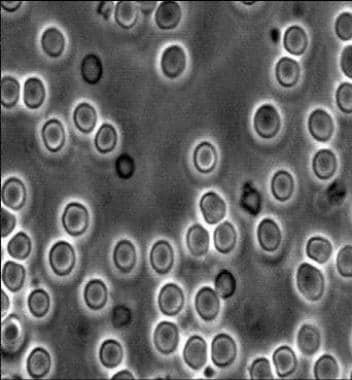 Microscopy of urinary sediment. Typical appearance