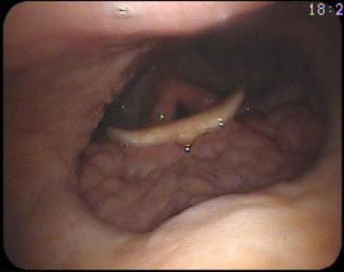 View of the larynx from the nasopharynx. Arytenoid