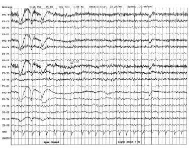 EEG in dementia. 