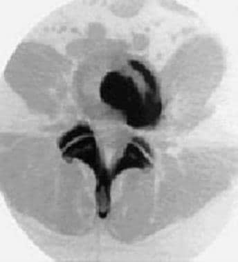 Postdiscography CT scan showing some abnormal dye 