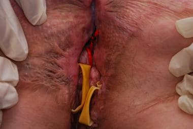 recurrent abscess