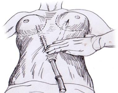 Transumbilical approach to breast augmentation. 