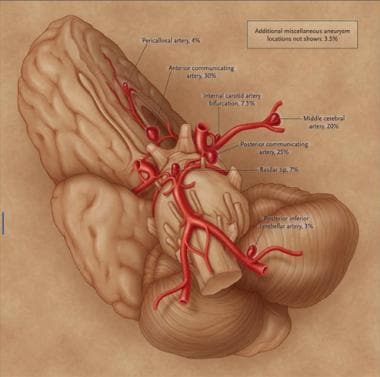 Common locations of cerebral saccular aneurysms, w