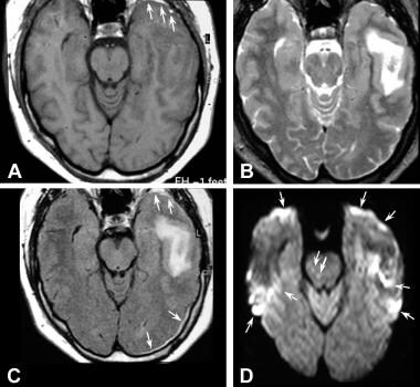 MRI in a 2-day-old brain contusion. (A) T1-weighte