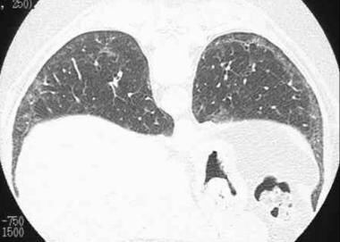 Differential diagnosis of drug-related lung diseas