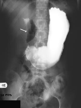 Pneumoperitoneum. Supine abdominal radiograph in a