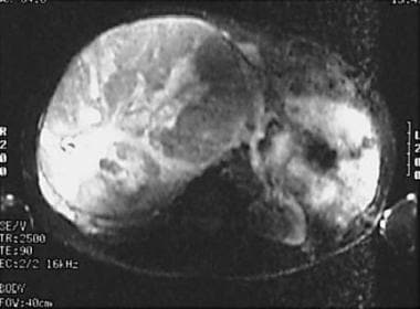 T2-weighted MRI demonstrates a large right adrenoc