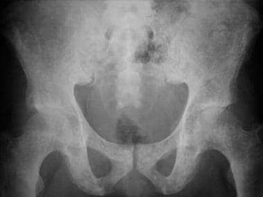 Osteopoikilosis. A plain film radiograph of the pe