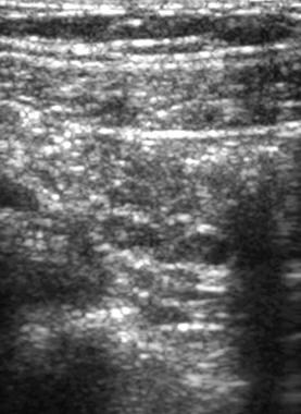 Sonogram of normal mesenteric lymph nodes shows th