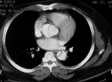 Contrast-enhanced axial CT image demonstrates an i