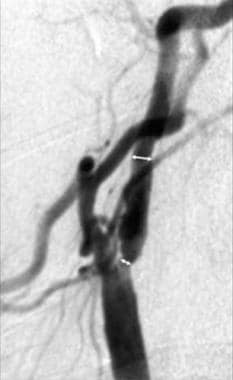 Lateral common carotid angiogram shows appropriate