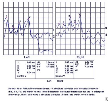 mr of th e normal and abnormal internal auditory canal