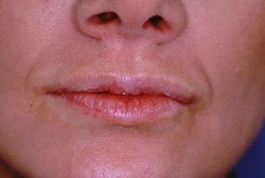 Patient prior to bovine collagen injection for lip