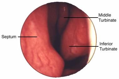 Endoscopic view from nares of left nasal passage. 