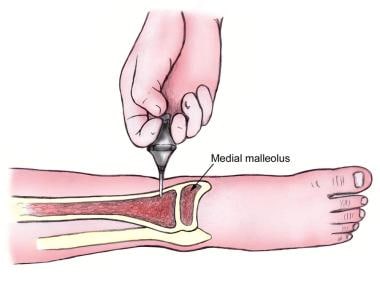 Distal tibia intraosseous needle insertion site. 