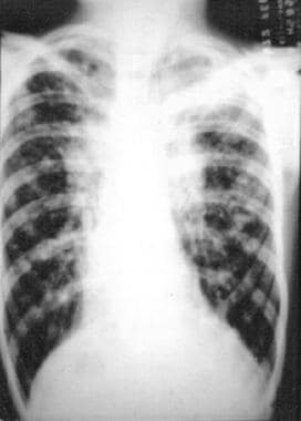 Chest radiograph of a patient with advanced cystic