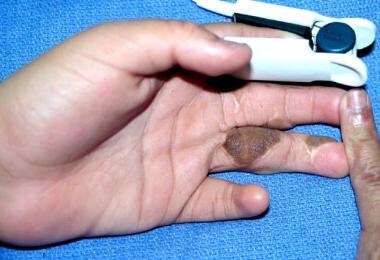 Hand of 18-year-old patient of Mediterranean herit