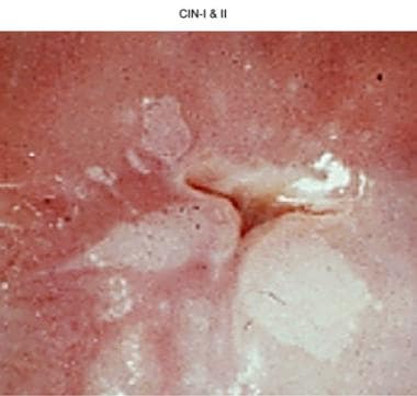 Cervical intraepithelial neoplasia, grades I and I