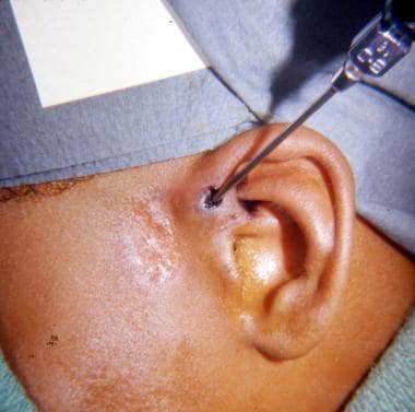 Steroids after sinus surgery