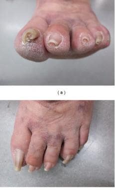 Pincer nail. Courtesy of Dermatology Research and 