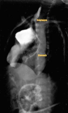 Contrast swallow (oblique view) demonstrating gast