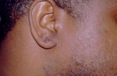 Ear lobe keloid scar postoperatively (same patient