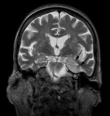 Coronal T2-weighted image reveals hyperintensity i