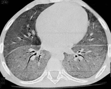 Differential diagnosis of drug-related lung diseas
