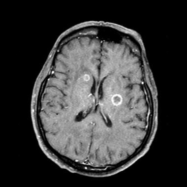 Lung cancer, small cell. Contrast-enhanced MRI of 