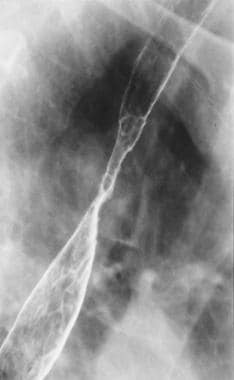 Spot radiograph from double-contrast esophagograph