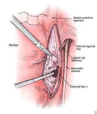 Pulsation from the external iliac artery helps to 
