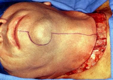 Incision typically performed for patients requirin