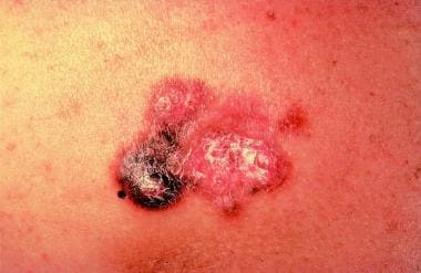 Bednar tumor, a pigmented variant of dermatofibros