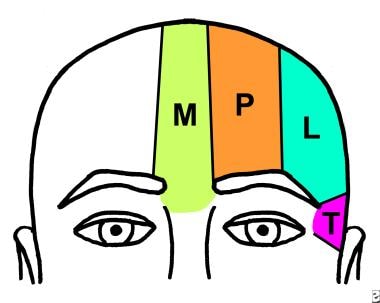 forehead temple paramedian midline reconstruction lateral treatment subunits divided into management areas