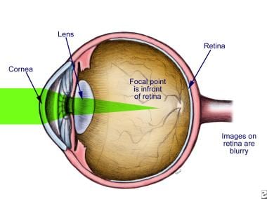 Illustration of myopia. 