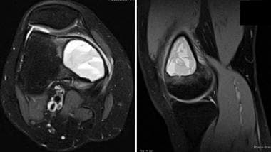 Axial and sagittal T2-weighted MRI of distal femor