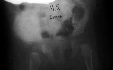 Radiograph from a 5-month-old infant with infantil