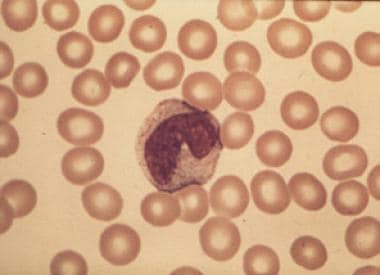 Peripheral blood smear from a patient with immune 
